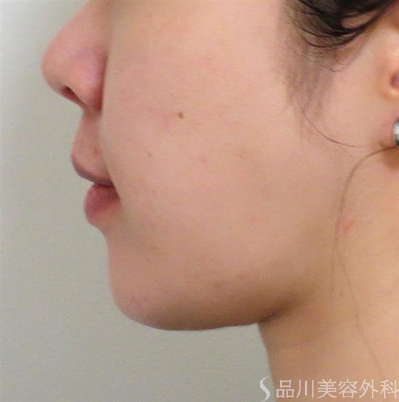 症例NO.37761のBEFORE写真