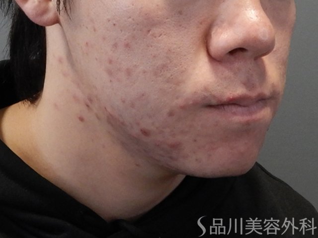 症例NO.69826のBEFORE写真