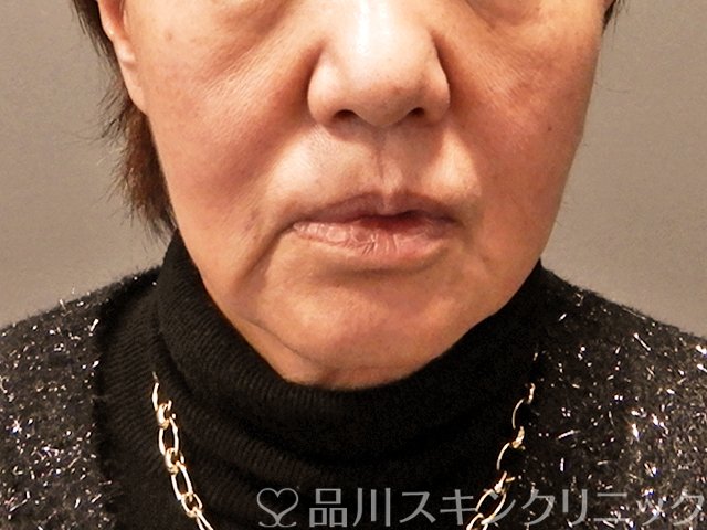 症例NO.69432のBEFORE写真