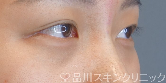 症例NO.72572のAFTER写真