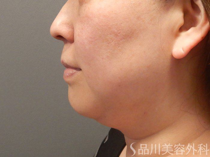 症例NO.69469のBEFORE写真
