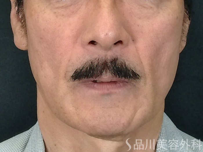 症例NO.70697のBEFORE写真