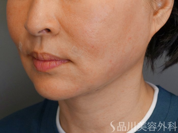 症例NO.70074のAFTER写真