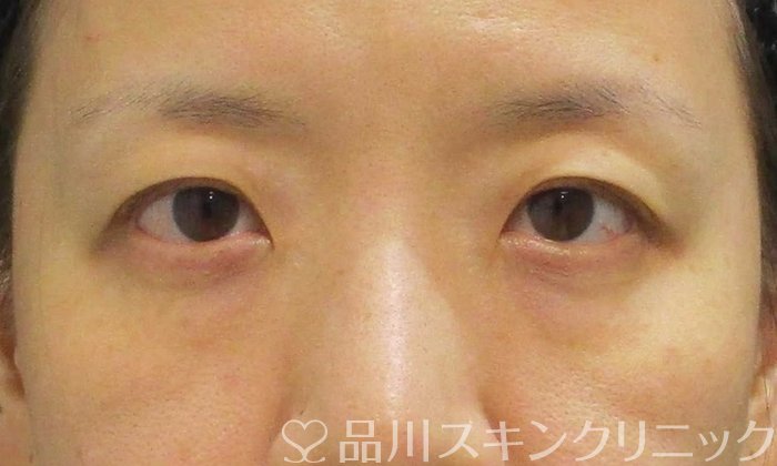 症例NO.67611のBEFORE写真