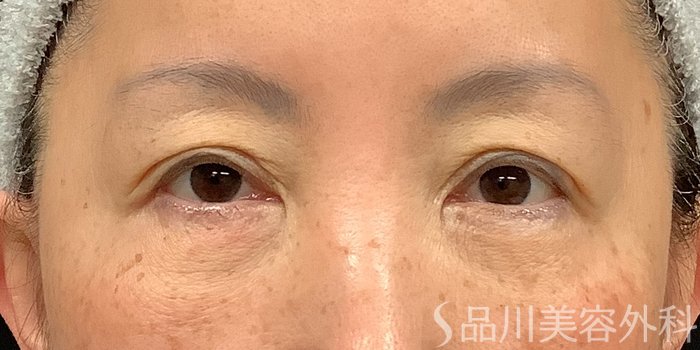 症例NO.73319のBEFORE写真