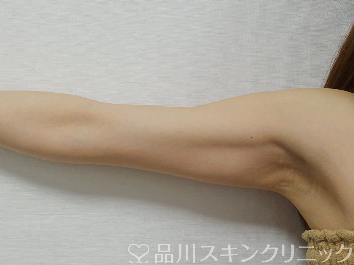 症例NO.75324のAFTER写真