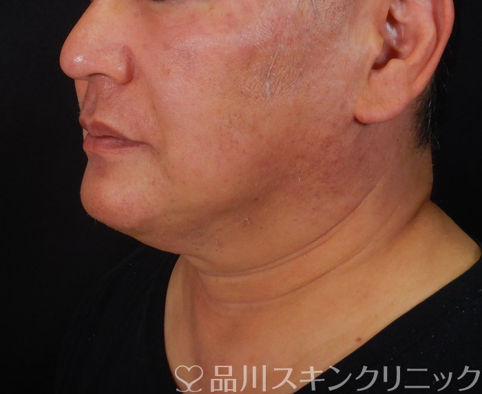 症例NO.65724のAFTER写真