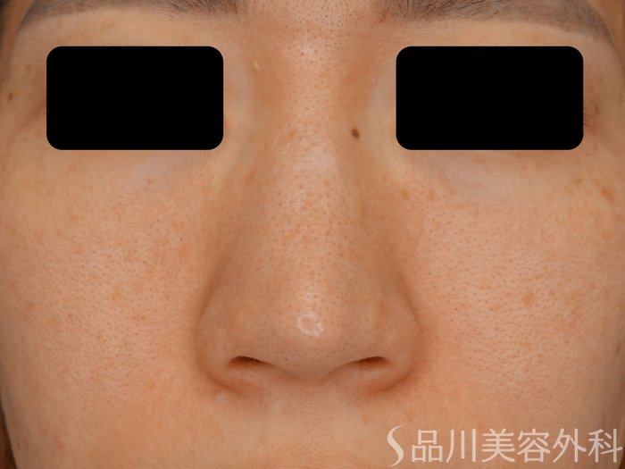 症例NO.72538のBEFORE写真