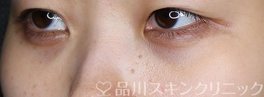 症例NO.67751のAFTER写真