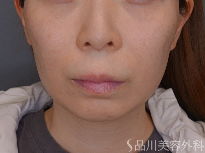 症例NO.74104のBEFORE写真