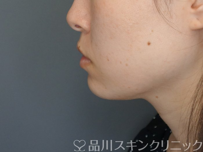 症例NO.72329のBEFORE写真