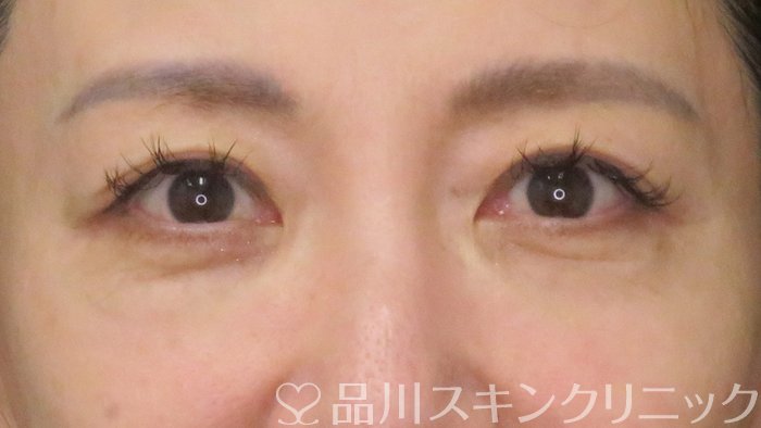 症例NO.70698のAFTER写真