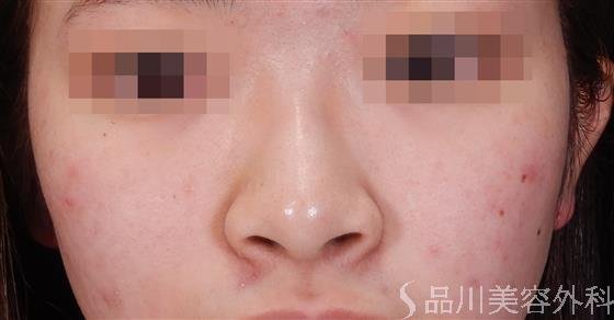 症例NO.56190のBEFORE写真