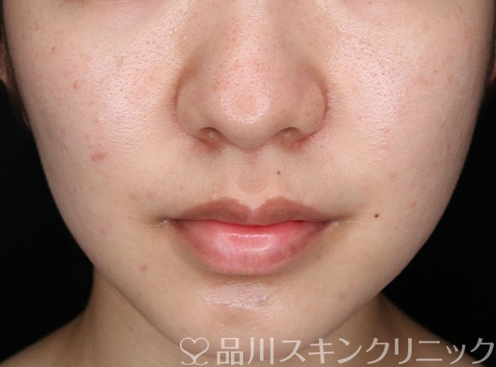 症例NO.70938のAFTER写真