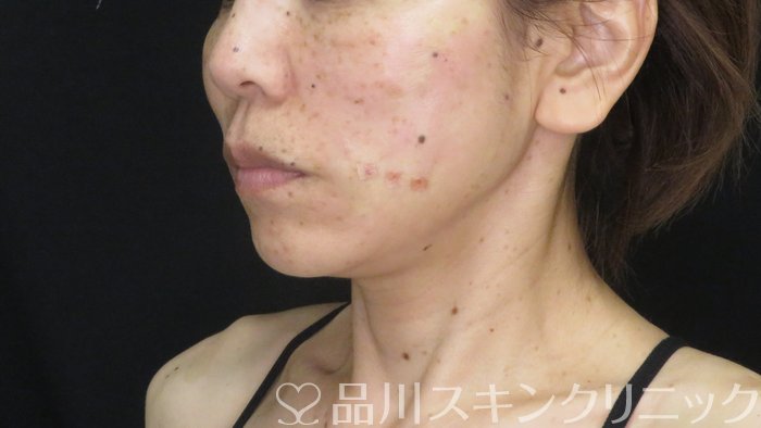 症例NO.72148のAFTER写真