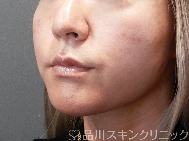 症例NO.68506のBEFORE写真