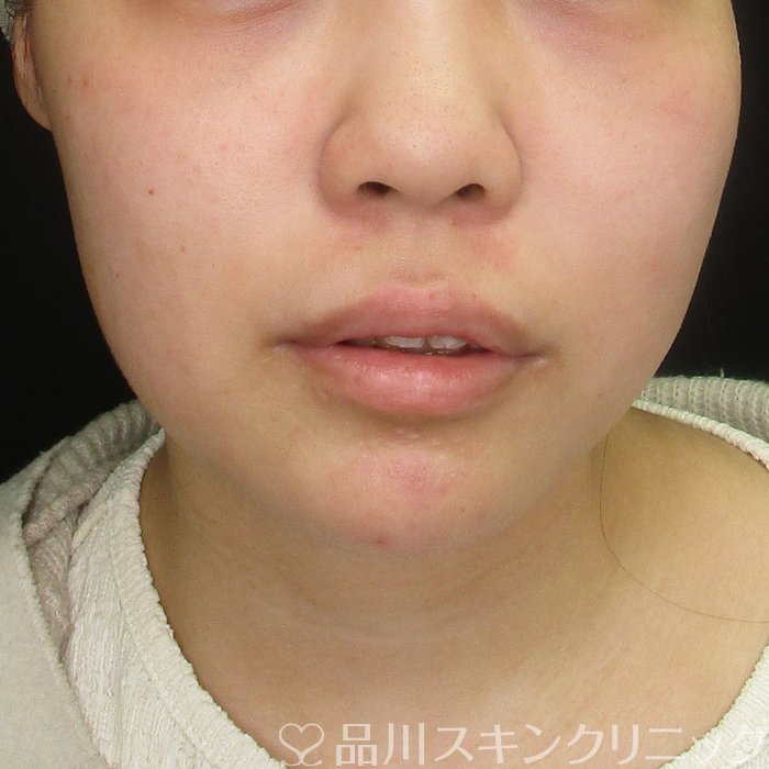 症例NO.70449のBEFORE写真
