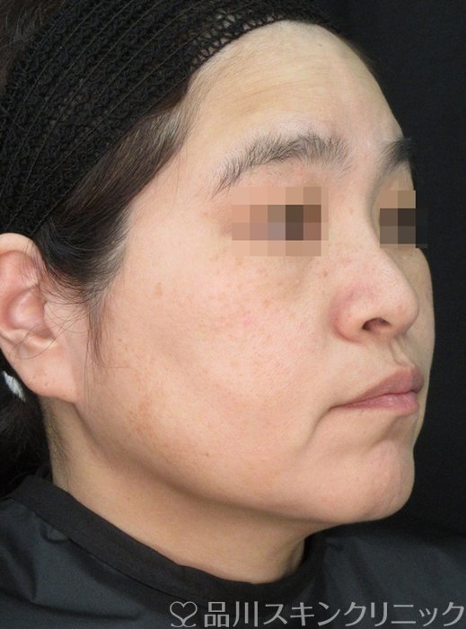 症例NO.72138のAFTER写真