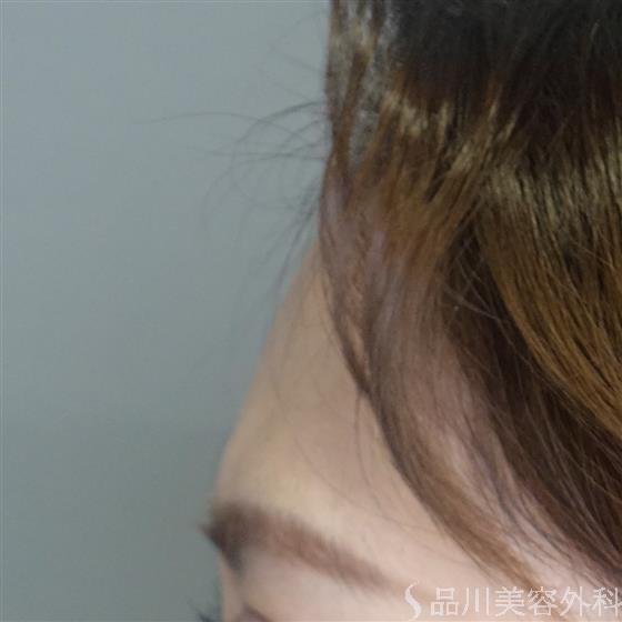 症例NO.50714のBEFORE写真