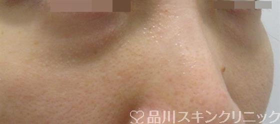 症例NO.35969のBEFORE写真