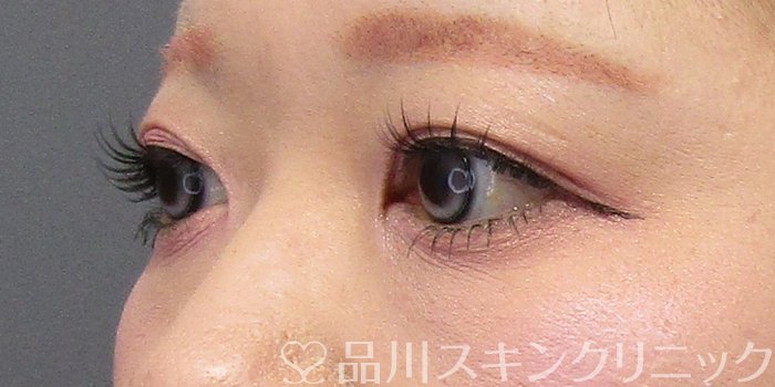 症例NO.74910のBEFORE写真