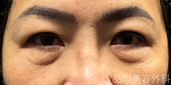 症例NO.70787のBEFORE写真