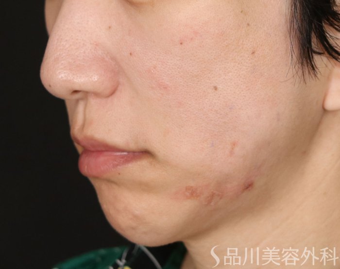 症例NO.71724のAFTER写真