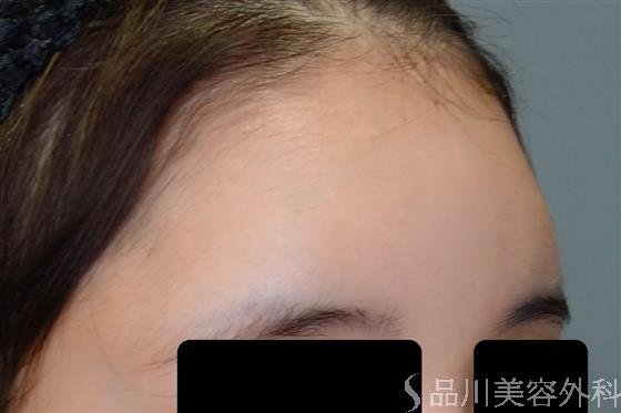 症例NO.50590のBEFORE写真