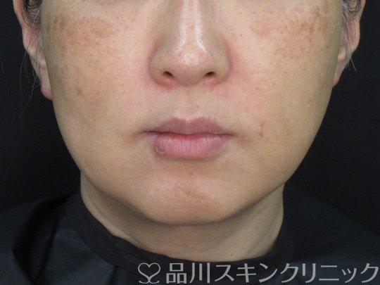 症例NO.72754のBEFORE写真