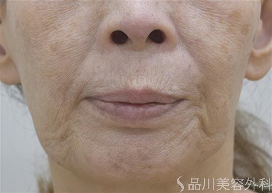 症例NO.45357のBEFORE写真