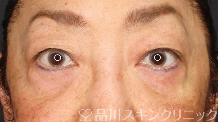症例NO.64610のAFTER写真