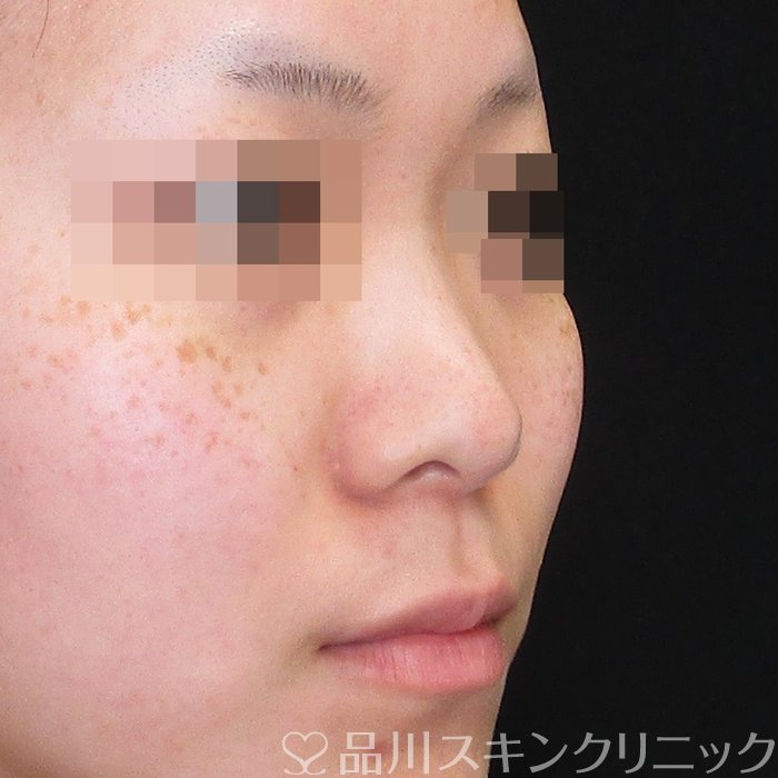 症例NO.74214のBEFORE写真