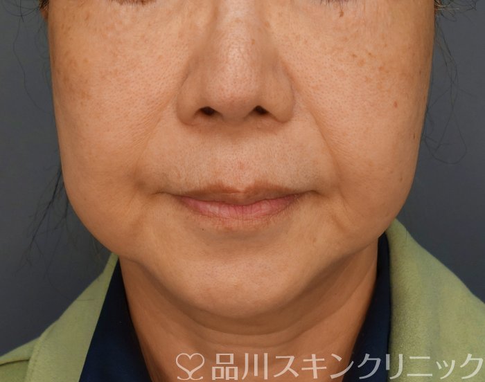 症例NO.74696のBEFORE写真