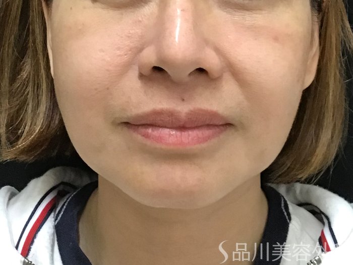 症例NO.69701のBEFORE写真