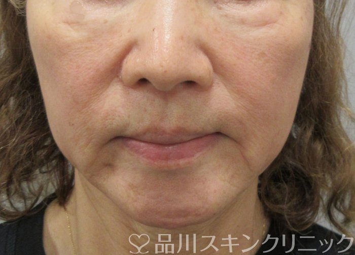 症例NO.72090のBEFORE写真