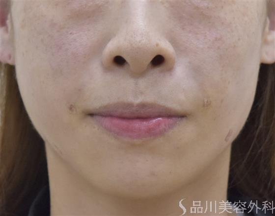 症例NO.51622のAFTER写真