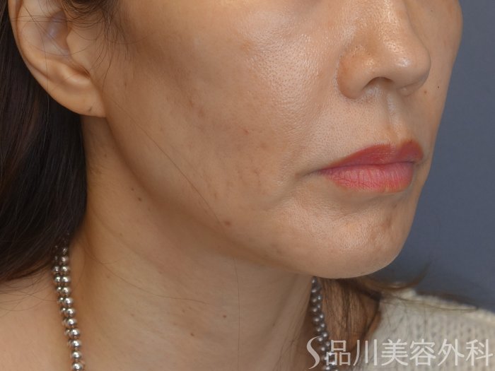 症例NO.72060のBEFORE写真