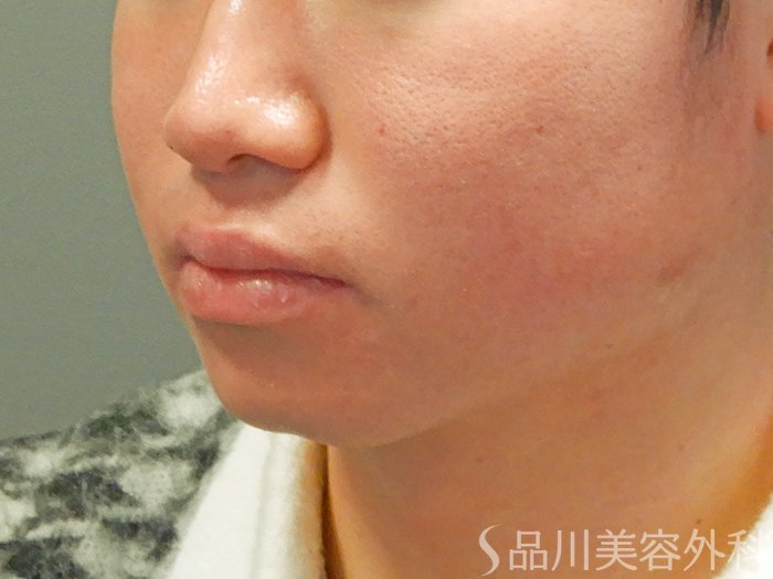 症例NO.69691のAFTER写真