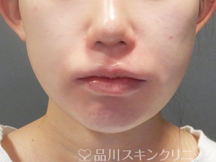 症例NO.73277のAFTER写真