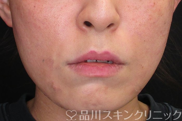 症例NO.73996のAFTER写真