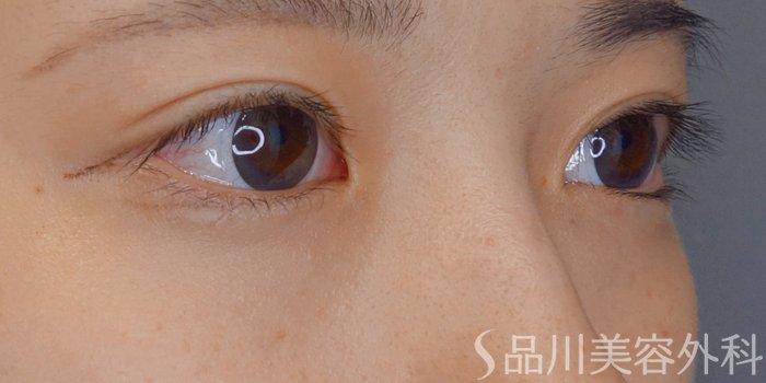 症例NO.71324のBEFORE写真