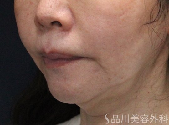 症例NO.75140のBEFORE写真