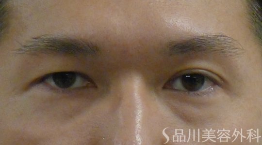 症例NO.63135のBEFORE写真