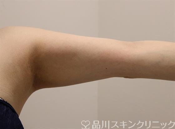 症例NO.49334のAFTER写真
