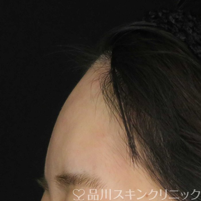 症例NO.62277のAFTER写真