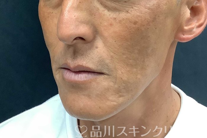症例NO.71042のAFTER写真