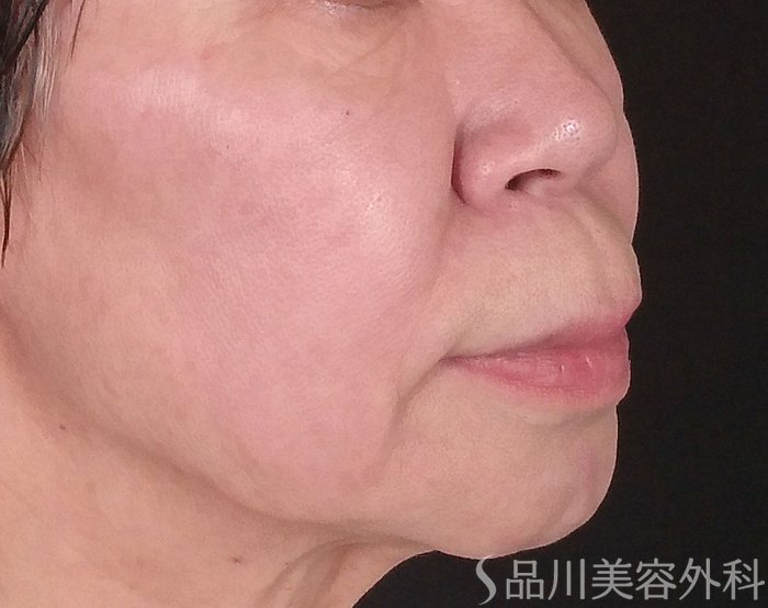 症例NO.70354のBEFORE写真
