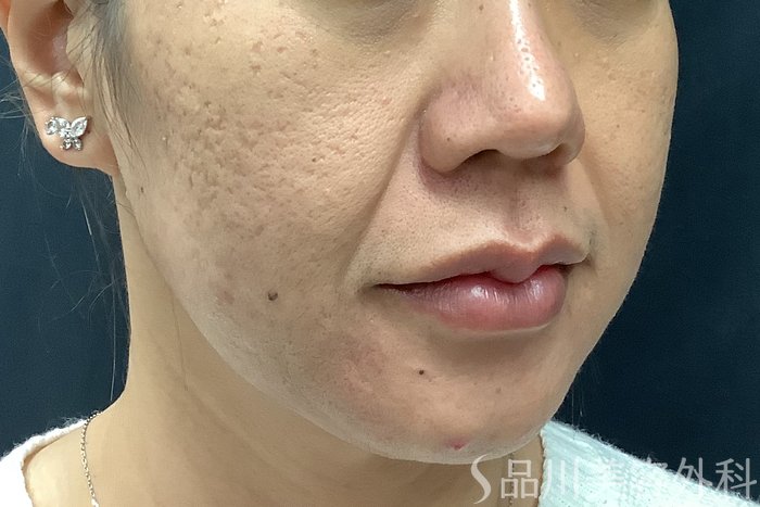 症例NO.73310のBEFORE写真