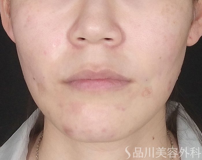 症例NO.65124のAFTER写真