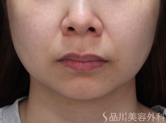 症例NO.73035のBEFORE写真